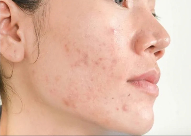 Thâm mụn là tình trạng da đổi màu sau mụn viêm, cần chăm sóc đúng để tránh thâm lâu và sẹo. 