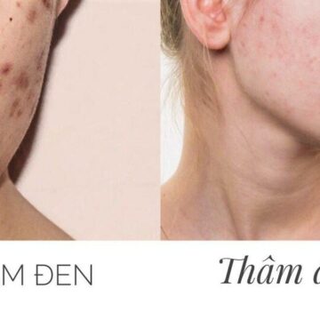 Muốn trị thâm mụn hiệu quả, cần xác định loại thâm và tình trạng da trước khi chọn sản phẩm. 