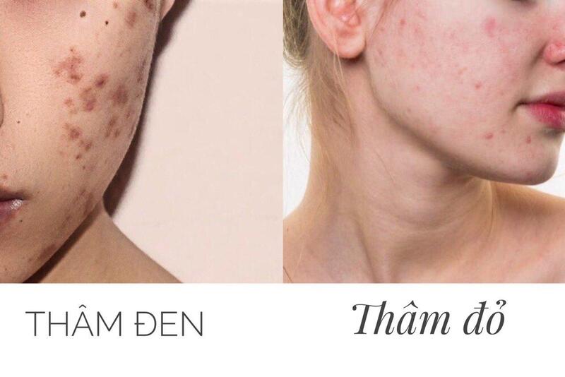 Muốn trị thâm mụn hiệu quả, cần xác định loại thâm và tình trạng da trước khi chọn sản phẩm. 