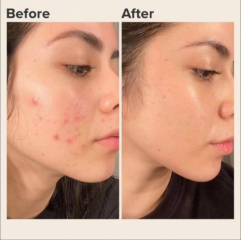 Da mặt nhạy cảm nên cần chọn cách trị thâm mụn dịu nhẹ, phù hợp và tránh nặn mụn sai cách. 