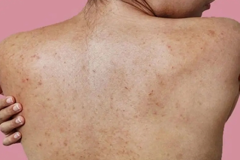Thâm mụn ở lưng, mông và cơ thể cần kết hợp làm sạch, giảm ma sát và dưỡng da phù hợp. 