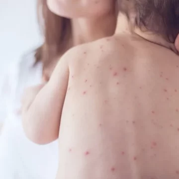Triệu chứng sốt xuất huyết ở trẻ em và dấu hiệu nguy hiểm