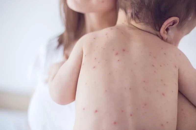 Triệu chứng sốt xuất huyết ở trẻ em và dấu hiệu nguy hiểm